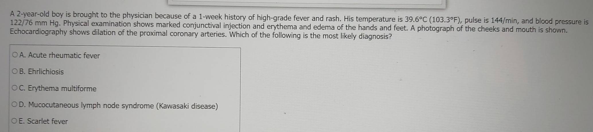 A 2-year-old boy is brought to the physician because of a 1-week history of high-grade fever and rash. His temperature is 39.6°C(103.3°F) , pulse is 144/min, and blood pressure is
122/76 mm Hg. Physical examination shows marked conjunctival injection and erythema and edema of the hands and feet. A photograph of the cheeks and mouth is shown.
Echocardiography shows dilation of the proximal coronary arteries. Which of the following is the most likely diagnosis?
A. Acute rheumatic fever
B. Ehrlichiosis
C. Erythema multiforme
D. Mucocutaneous lymph node syndrome (Kawasaki disease)
E. Scarlet fever