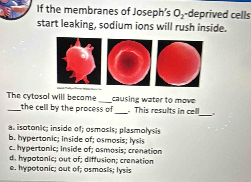 If the membranes of Joseph's O_2 -deprived cells
start leaking, sodium ions will rush inside.
The cytosol will become _causing water to move
_
_the cell by the process of_ . This results in cell
a. isotonic; inside of; osmosis; plasmolysis
b. hypertonic; inside of; osmosis; lysis
c. hypertonic; inside of; osmosis; crenation
d. hypotonic; out of; diffusion; crenation
e. hypotonic; out of; osmosis; lysis