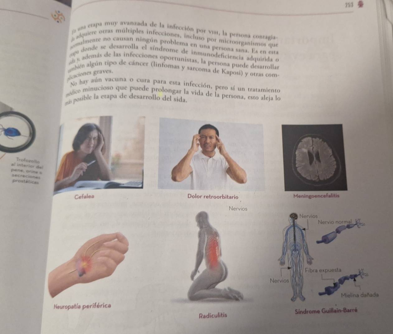 253
_
_
f una etapa muy avanzada de la infección por v111, la persona contagia
adquiere otras múltiples infecciones, incluso por microorganismos que
ormalmente no causan ningún problema en una persona sana. Es en esta
eapa donde se desarrolla el síndrome de inmunodeficiencia adquirida o
sd y además de las infecciones oportunistas, la persona puede desarrollar
ambién algún tipo de cáncer (linfomas y sarcoma de Kaposi) y otras com-
plicaciones graves.
No hay aún vacuna o cura para esta infección, pero sí un tratamiento
médico minucioso que puede prolongar la vida de la persona, esto aleja lo
más posible la etapa de desarrollo del sida.
Trofozolto
al interior del
pene, orine e secreciones
prostáticas
Cefales Dolor retroorbitario
Nervios
Neuropatía periférica
Radiculitis