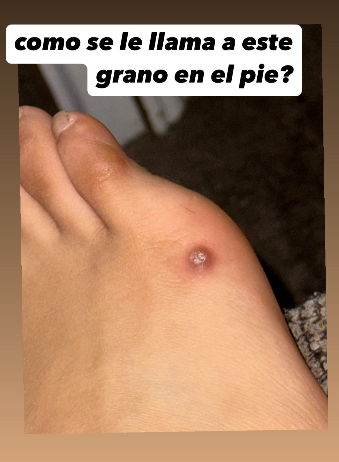 como se le llama a este 
grano en el pie?