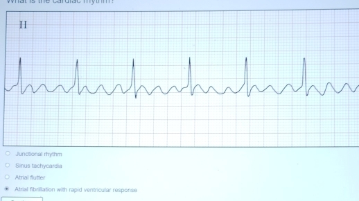 Sinus tachycardia
Atrial flutter
Atrial fibrillation with rapid ventricular response