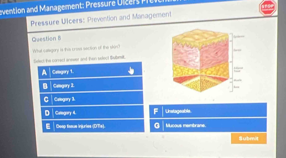 STOP
evention and Management: ressure lcr 
Pressure Ulcers: Prevention and Management
Question 8
What category is this cross section of the skin?
Select the correct answer and then select Submit.
A Category 1.
Category 2.
Category 3.
F
Category 4. Unstageable.
Deep tissue injuries (DTIs). G Mucous membrane.
Submit