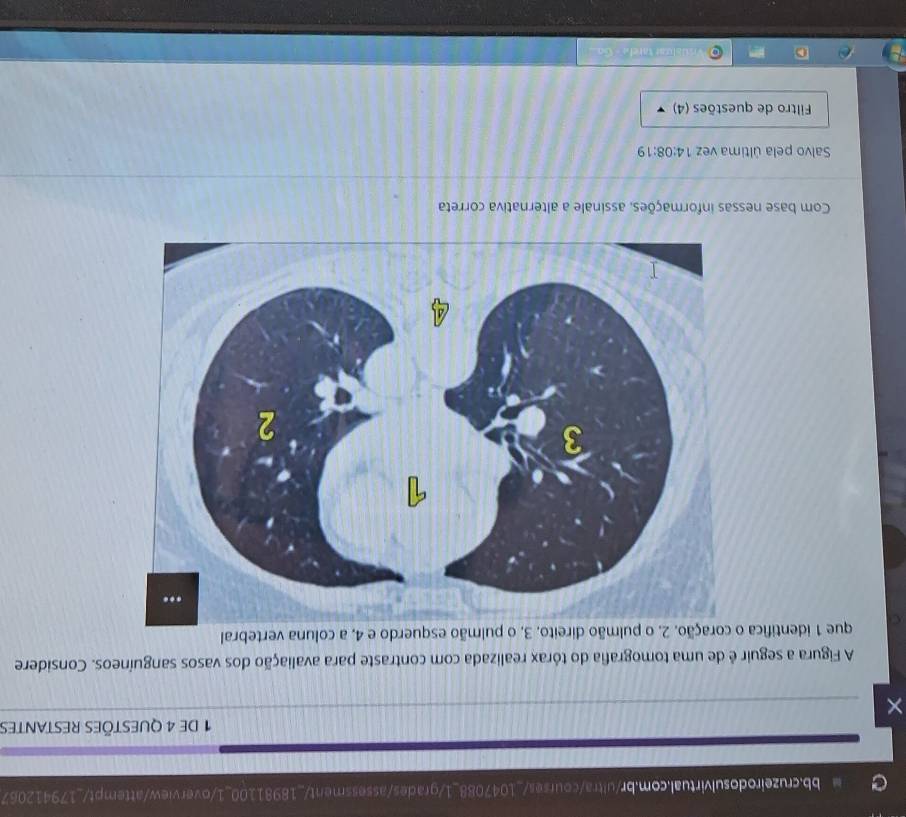 de 4 Questões restantes 
× 
A Figura a seguir é de uma tomografia do tórax realizada com contraste para avaliação dos vasos sanguíneos. Considere 
que 1 identifica o pulmão esquerdo e 4, a coluna vertebral 
Com base nessas informações, assinale a alternativa correta 
Salvo pela última vez 14:08:19
Filtro de questões (4)