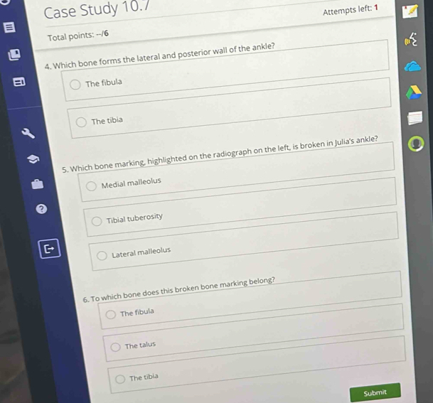 Case Study 10.7
Total points: --/6 Attempts left: 1
4. Which bone forms the lateral and posterior wall of the ankle?
The fibula
The tibia
5. Which bone marking, highlighted on the radiograph on the left, is broken in Julia's ankle?
Medial malleolus
Tibial tuberosity
Lateral malleolus
6. To which bone does this broken bone marking belong?
The fibula
The talus
The tibia
Submit