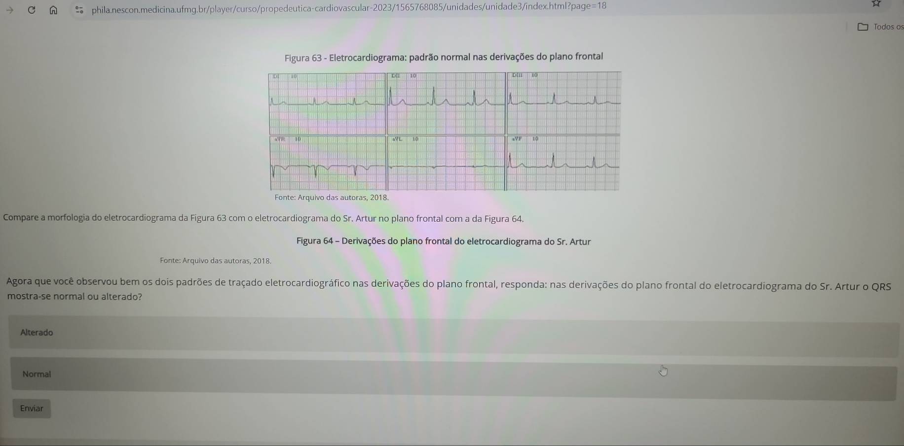page=18
Todos os
Figura 63 - Eletrocardiograma: padrão normal nas derivações do plano frontal
Compare a morfologia do eletrocardiograma da Figura 63 com o eletrocardiograma do Sr. Artur no plano frontal com a da Figura 64.
Figura 64 - Derivações do plano frontal do eletrocardiograma do Sr. Artur
Fonte: Arquivo das autoras, 2018.
Agora que você observou bem os dois padrões de traçado eletrocardiográfico nas derivações do plano frontal, responda: nas derivações do plano frontal do eletrocardiograma do Sr. Artur o QRS
mostra-se normal ou alterado?
Alterado
Normal
Enviar
