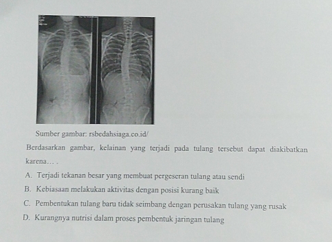 Sumber gambar: rsbedahsiaga.co.id/
Berdasarkan gambar, kelainan yang terjadi pada tulang tersebut dapat diakibatkan
karena…. .
A. Terjadi tekanan besar yang membuat pergeseran tulang atau sendi
B. Kebiasaan melakukan aktivitas dengan posisi kurang baik
C. Pembentukan tulang baru tidak seimbang dengan perusakan tulang yang rusak
D. Kurangnya nutrisi dalam proses pembentuk jaringan tulang