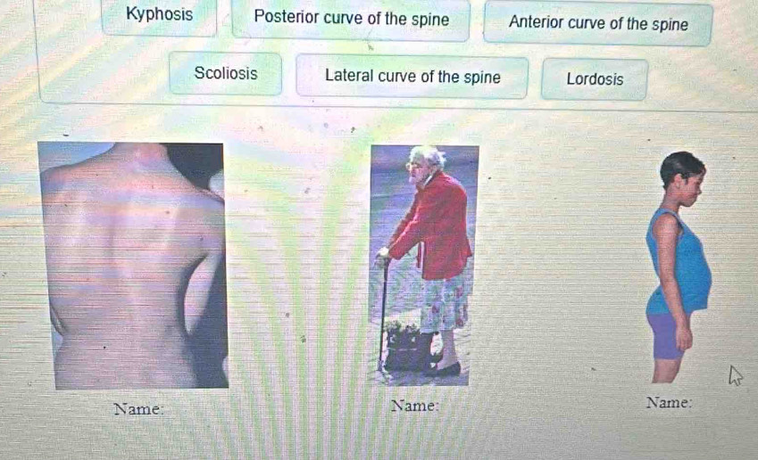 Kyphosis Posterior curve of the spine Anterior curve of the spine
Scoliosis Lateral curve of the spine Lordosis
Name: Name: Name: