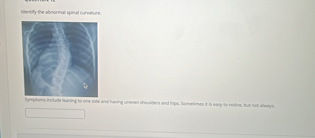 Identify the abnormal spinal curvature. 
Symptoms include leaning to one side and having uneven shoulders and hips. Sometimes it is easy to notice, but not always.