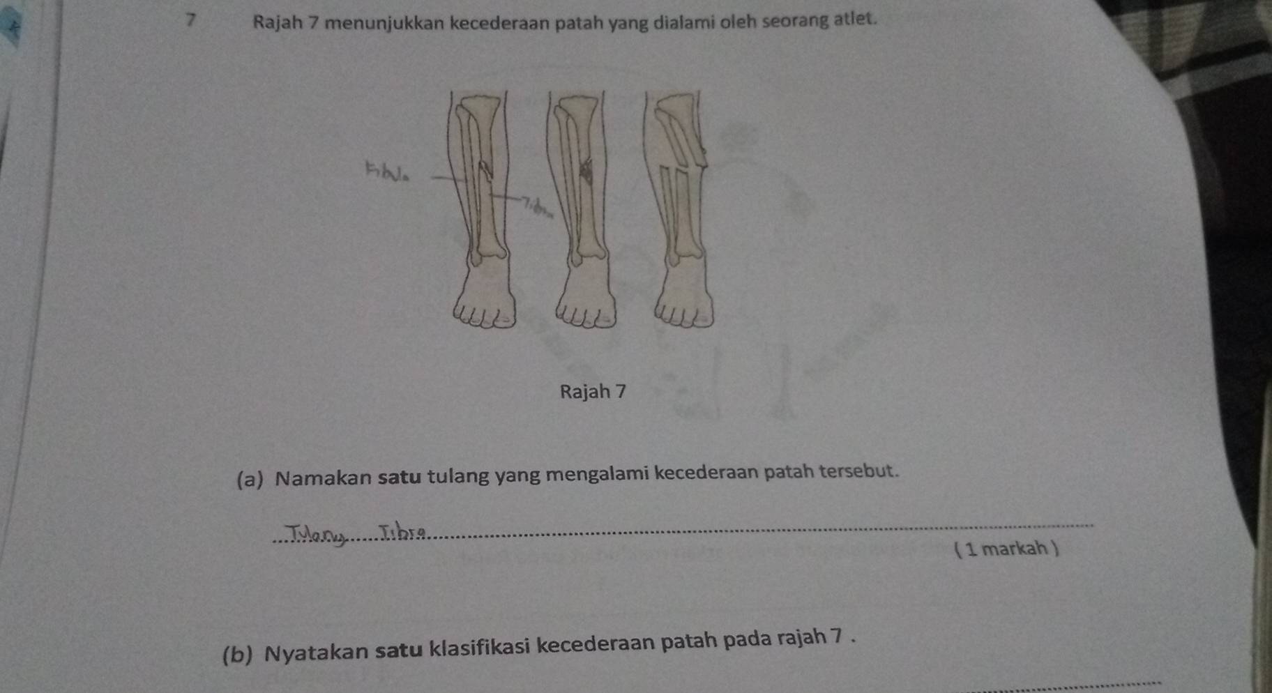 Rajah 7 menunjukkan kecederaan patah yang dialami oleh seorang atlet. 
Rajah 7 
(a) Namakan satu tulang yang mengalami kecederaan patah tersebut. 
_ 
( 1 markah ) 
(b) Nyatakan satu klasifikasi kecederaan patah pada rajah 7 . 
_