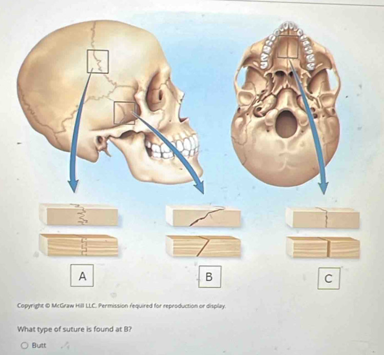 What type of suture is found at B? 
Butt