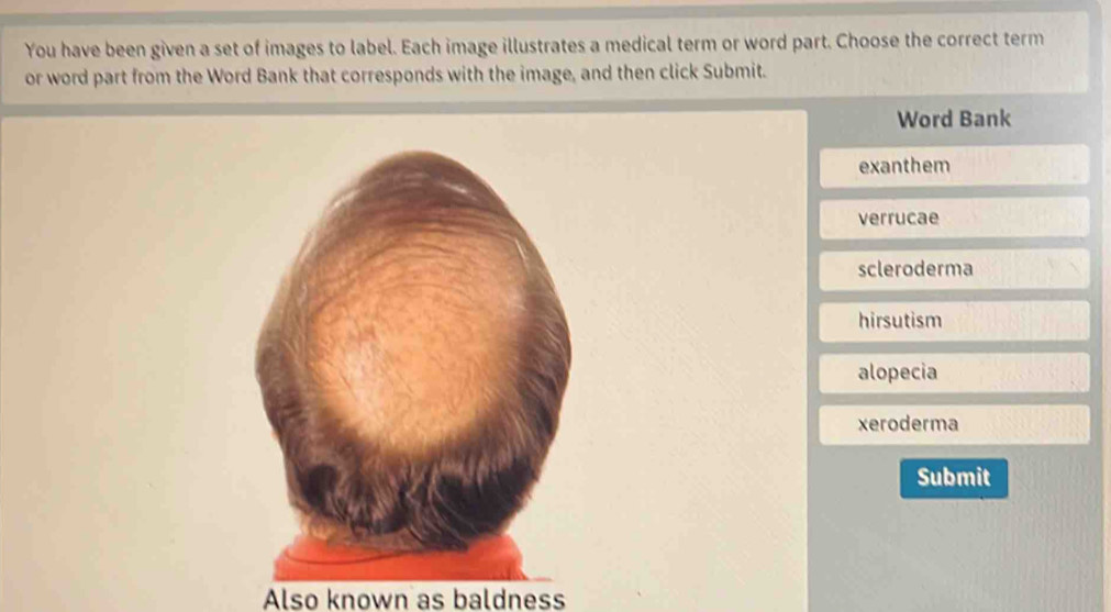 You have been given a set of images to label. Each image illustrates a medical term or word part. Choose the correct term
or word part from the Word Bank that corresponds with the image, and then click Submit.
Word Bank
exanthem
verrucae
scleroderma
hirsutism
alopecia
xeroderma
Submit
Also known as baldness