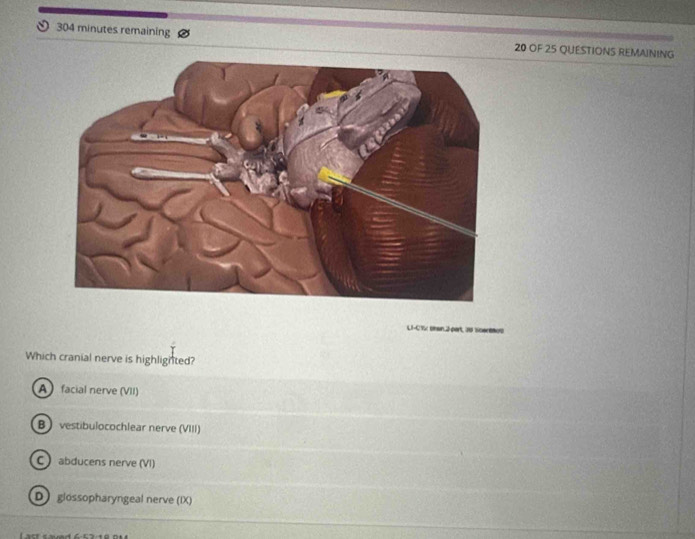 304 minutes remaining 20 OF 25 QUESTIONS REMAINING
L1-CTx enan.2-part, 30 scereaus
Which cranial nerve is highlighted?
A facial nerve (VII)
B vestibulocochlear nerve (VIII)
C abducens nerve (VI)
D glössopharyngeal nerve (IX)