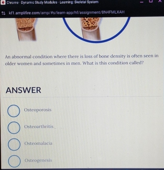 Chrome - Dynamic Study Modules - Learning: Skeletal System
kf1.amplifıre.com/amp/#s/learn-app/hf/assignment/8N4FMLXAH
An abnormal condition where there is loss of bone density is often seen in
older women and sometimes in men. What is this condition called?
ANSWER
Osteoporosis
Osteoarthritis
Osteomalacia
Osteogenesis