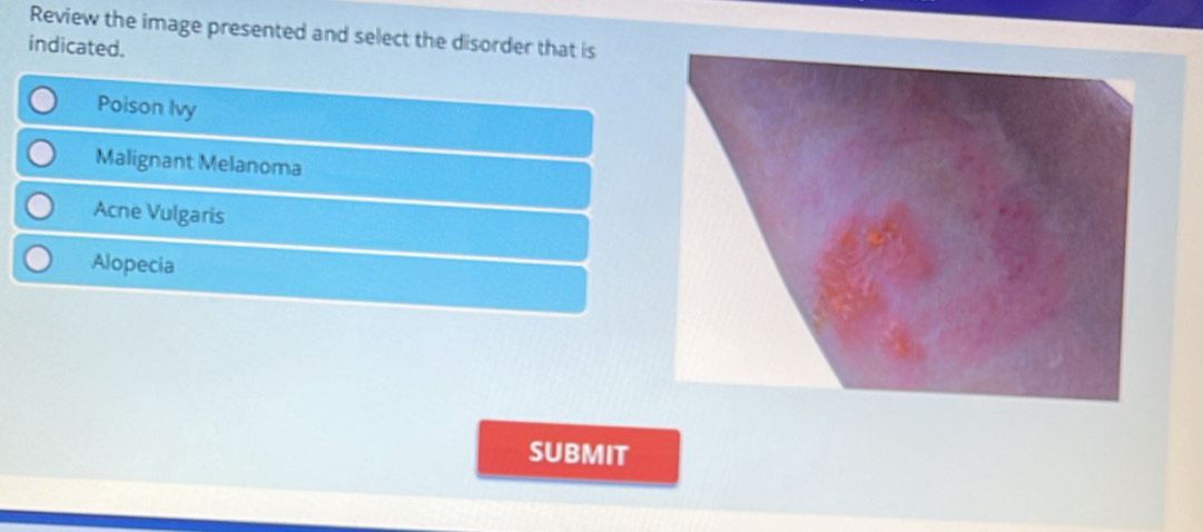 Review the image presented and select the disorder that is
indicated.
Poison Ivy
Malignant Melanoma
Acne Vulgaris
Alopecia
SUBMIT