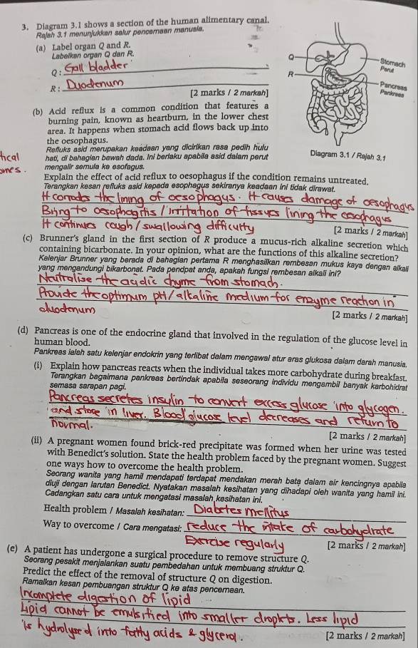 Diagram 3.1 shows a section of the human alimentary canal.
Rajsh 3.1 menunjukkan salur pencemaan manusia.
(a) Label organ Q and R.
Labelkan organ Q dan R.
_
Q:
R :
_
[2 marks / 2 markah]
(b) Acid reflux is a common condition that features a
burning pain, known as heartburn, in the lower chest
area. It happens when stomach acid flows back up into
the oesophagus.
Refluks asid merupakan keadaan yang dicirikan rasa pedih hulu
hati, di bahagian bawah dada. Ini berlaku apabila asid dalam perut
mengalir semula ke esofagus.
Explain the effect of acid reflux to oesophagus if the condition remains untreated.
Terangkan kesan refluks asid kepada esophagus sekiranya keadaan ini tidak dirawat.
Contínues
[2 marks / 2 markah]
(c) Brunner's gland in the first section of R produce a mucus-rich alkaline secretion which
containing bicarbonate. In your opinion, what are the functions of this alkaline secretion?
Kelenjar Brunner yang berada di bahagian pertama R menghasilkan rembesan mukus kaya dengan alkaii
yang mengandungi bikarbonat. Pada pendpat anda, apakah fungsi rembesan alkali ini?
[2 marks / 2 markah]
(d) Pancreas is one of the endocrine gland that involved in the regulation of the glucose level in
human blood.
Pankreas ialah satu kelenjar endokrin yang terlibat dalam mengawal atur aras glukosa dalam darah manusia.
(i) Explain how pancreas reacts when the individual takes more carbohydrate during breakfast.
Terangkan bagaimana pankreas bertindak apabila seseorang individu mengambil banyak karbohidrat
semasa sarapan pagi.
normal
[2 marks / 2 markah]
(ii) A pregnant women found brick-red precipitate was formed when her urine was tested
with Benedict’s solution. State the health problem faced by the pregnant women. Suggest
one ways how to overcome the health problem.
Seorang wanita yang hamil mendapati terdapat mendakan merah bata dalam air kencingnya apabila
diuji dengan larutan Benedict. Nyatakan masalah kesihatan yang dihadapi oleh wanita yang hamil ini.
Cadangkan satu cara untuk mengatasi masalah kesihatan ini.
_
Health problem / Masalah kesihatan:
_
_
Way to overcome / Cara mengatasi:
[2 marks / 2 markah]
(e) A patient has undergone a surgical procedure to remove structure Q.
Seorang pesakit menjalankan suatu pembedahan untuk membuang struktur Q.
Predict the effect of the removal of structure Q on digestion.
Ramalkan kesan pembuangan struktur Q ke atas pencemaan.
[2 marks / 2 markah]