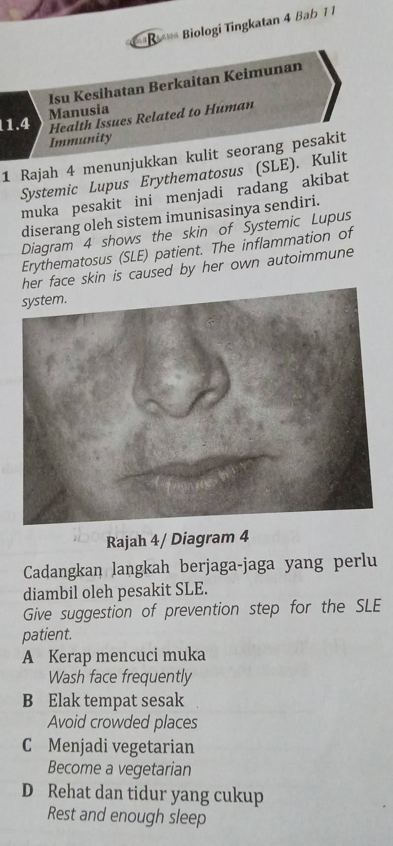 a ave Biologi Tingkatan 4 Bab 11
Isu Kesihatan Berkaitan Keimunan
Manusia
1.4 Health Issues Related to Human
Immunity
1 Rajah 4 menunjukkan kulit seorang pesakit
Systemic Lupus Erythematosus (SLE). Kulit
muka pesakit ini menjadi radang akibat
diserang oleh sistem imunisasinya sendiri.
Diagram 4 shows the skin of Systemic Lupus
Erythematosus (SLE) patient. The inflammation of
her face skin is caused by her own autoimmune 
Rajah 4/ Diagram 4
Cadangkan langkah berjaga-jaga yang perlu
diambil oleh pesakit SLE.
Give suggestion of prevention step for the SLE
patient.
A Kerap mencuci muka
Wash face frequently
B Elak tempat sesak
Avoid crowded places
C Menjadi vegetarian
Become a vegetarian
D Rehat dan tidur yang cukup
Rest and enough sleep