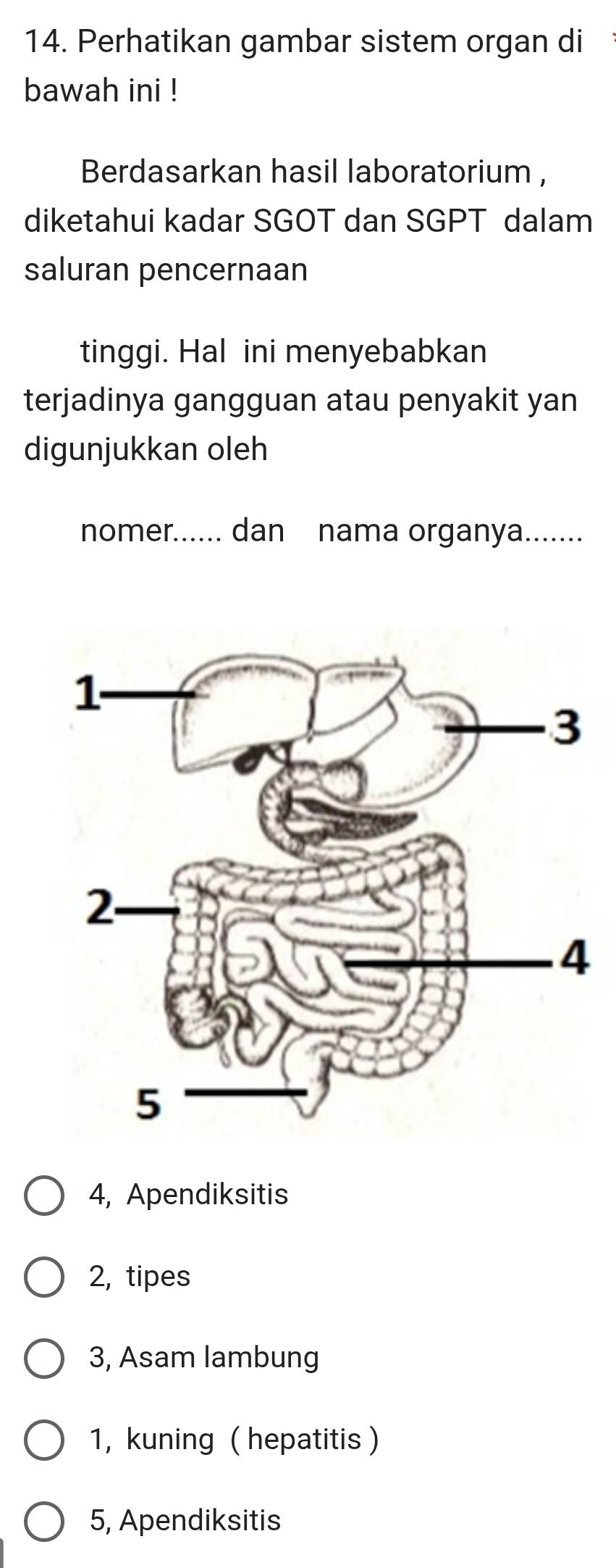 Perhatikan gambar sistem organ di
bawah ini !
Berdasarkan hasil laboratorium ,
diketahui kadar SGOT dan SGPT dalam
saluran pencernaan
tinggi. Hal ini menyebabkan
terjadinya gangguan atau penyakit yan
digunjukkan oleh
nomer...... dan nama organya.......
4, Apendiksitis
2, tipes
3, Asam lambung
1, kuning ( hepatitis )
5, Apendiksitis