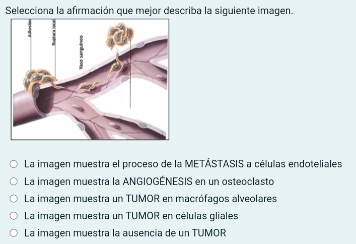 Selecciona la afirmación que mejor describa la siguiente imagen.
La imagen muestra el proceso de la METÁSTASIS a células endoteliales
La imagen muestra la ANGIOGÉNESIS en un osteoclasto
La imagen muestra un TUMOR en macrófagos alveolares
La imagen muestra un TUMOR en células gliales
La imagen muestra la ausencia de un TUMOR