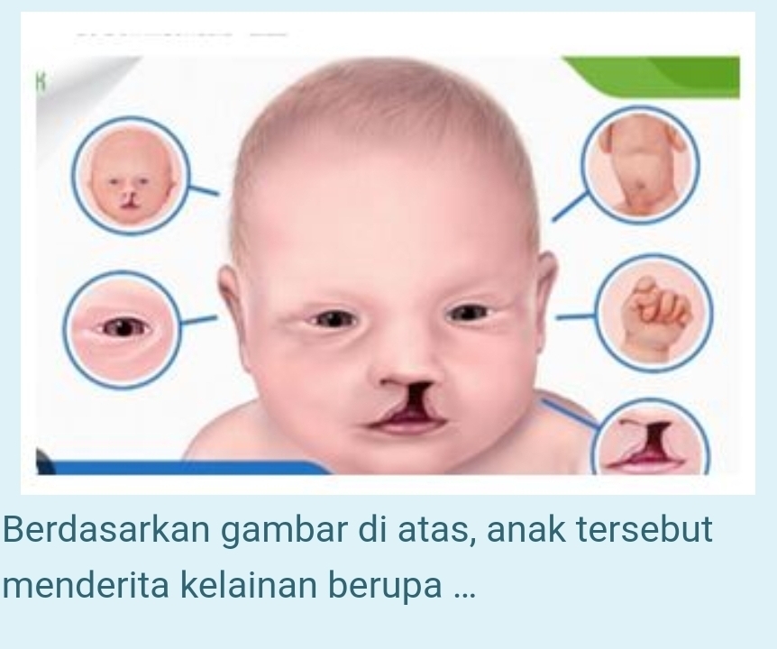 Berdasarkan gambar di atas, anak tersebut 
menderita kelainan berupa ...