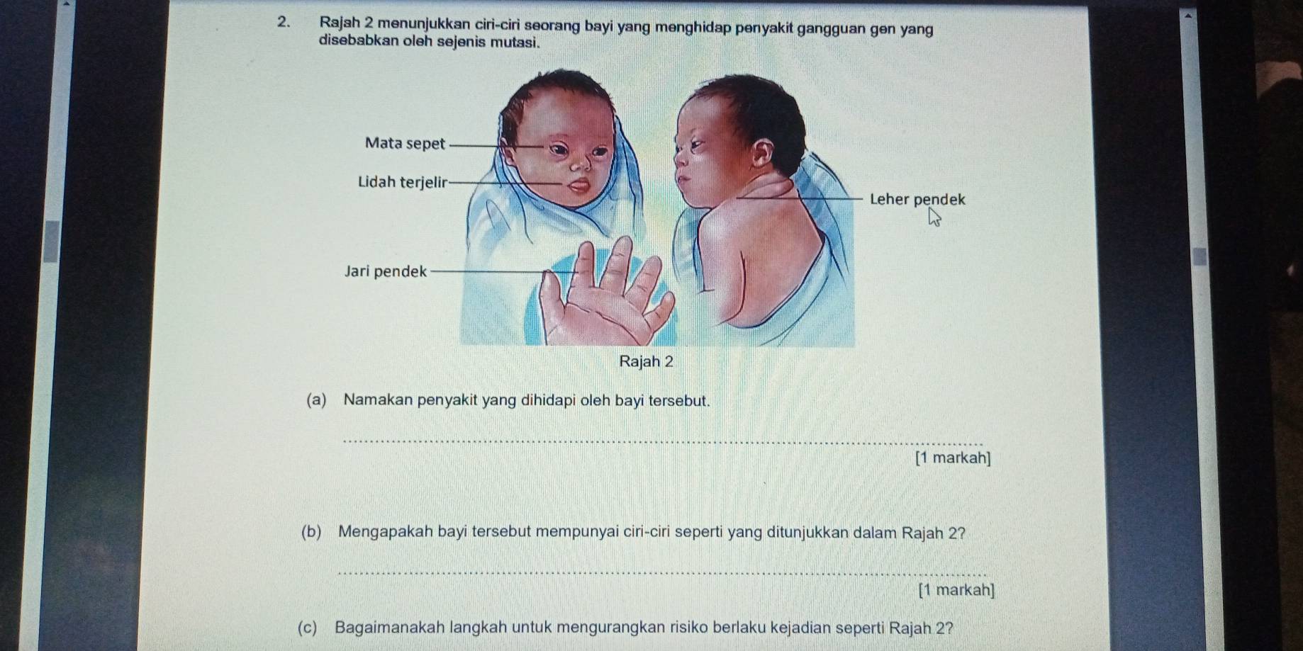 Rajah 2 menunjukkan ciri-ciri seorang bayi yang menghidap penyakit gangguan gen yang 
disebabkan oleh sejenis mutasi. 
(a) Namakan penyakit yang dihidapi oleh bayi tersebut. 
_ 
[1 markah] 
(b) Mengapakah bayi tersebut mempunyai ciri-ciri seperti yang ditunjukkan dalam Rajah 2? 
_ 
[1 markah] 
(c) Bagaimanakah langkah untuk mengurangkan risiko berlaku kejadian seperti Rajah 2?