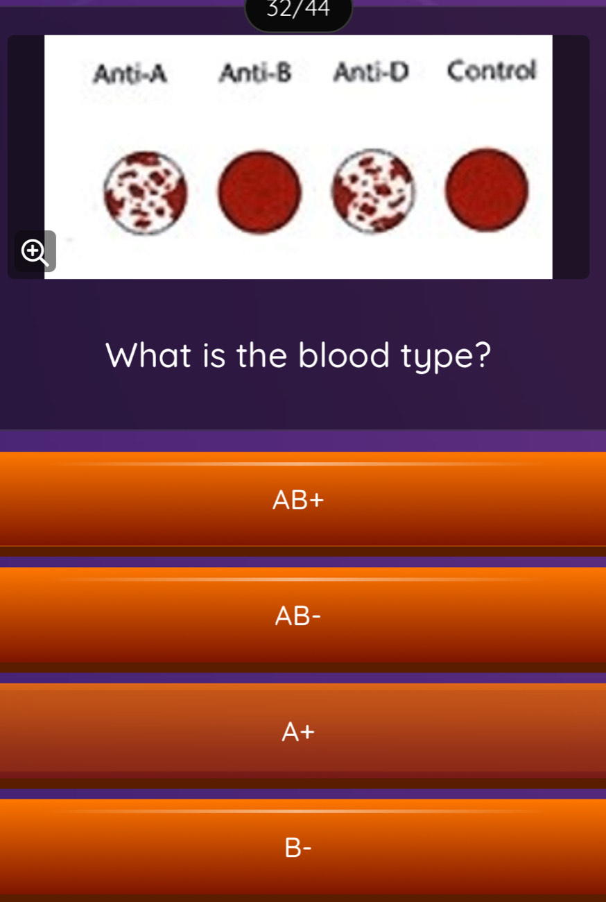 32/44
Anti-A Anti-B Anti-D Control

What is the blood type?
AB+
AB-
. A+