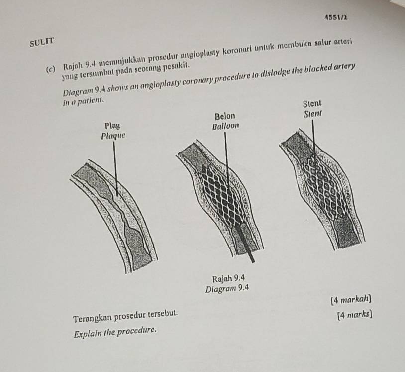 4551/2 
SULIT 
(c) Rajah 9.4 menunjukkan prosedur angioplasty koronari untuk membuka salur arteri 
yang tersumbat pada seorang pesakit. 
Diagram 9.4 shows an angioplasty coronary procedure to dislodge the blocked artery 
in a patient. 
Stent 
Belon Stent 
Balloon 
a 
Rajah 9.4 
Diagram 9.4 
Terangkan prosedur tersebut. [4 markah] 
Explain the procedure. [4 marks]