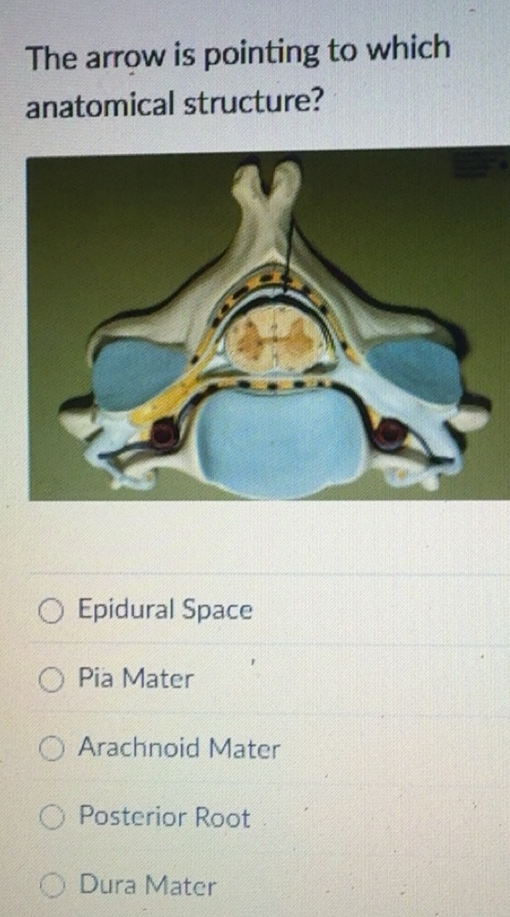 Solved: The arrow is pointing to which anatomical structure? Epidural ...
