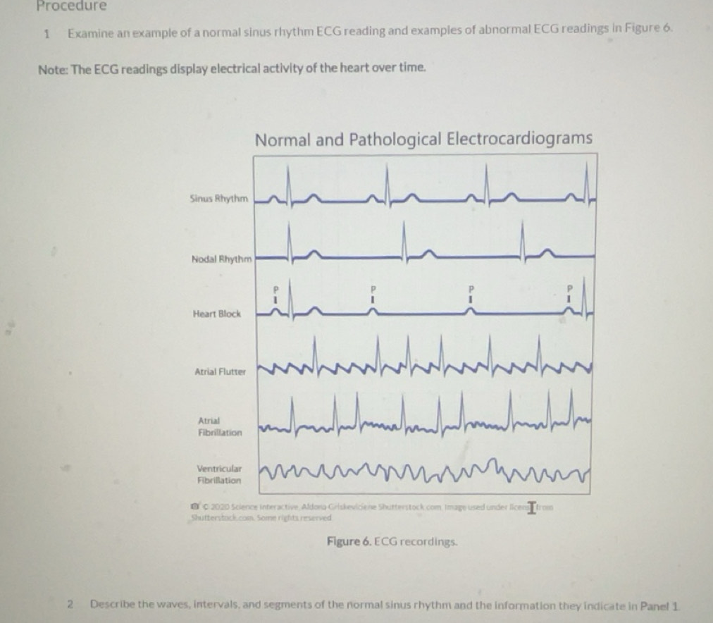 Solved: Procedure 1 Examine an example of a normal sinus rhythm ECG ...