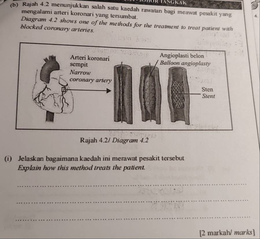 für Tängkak 
(b) Rajah 4.2 menunjukkan salah satu kaedah rawatan bagi meawat pesakit yang 4. 
mengalami arteri koronari yang tersumbat. 
Diagram 4.2 shows one of the methods for the treatment to treat patient with 
blocked coronary arteries. 
Rajah 4.2/ Diagram 4.2 
(i) Jelaskan bagaimana kaedah ini merawat pesakit tersebut 
Explain how this method treats the patient. 
_ 
_ 
_ 
[2 markah/ marks]