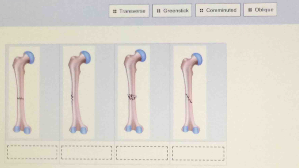 Transverse = Greenstick Comminuted Oblique