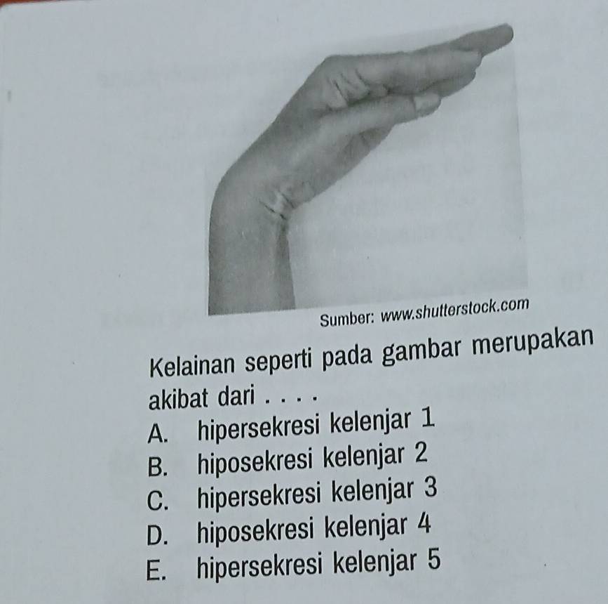 Kelainan seperti pada gambar merupakan
akibat dari . . . .
A. hipersekresi kelenjar 1
B. hiposekresi kelenjar 2
C. hipersekresi kelenjar 3
D. hiposekresi kelenjar 4
E. hipersekresi kelenjar 5