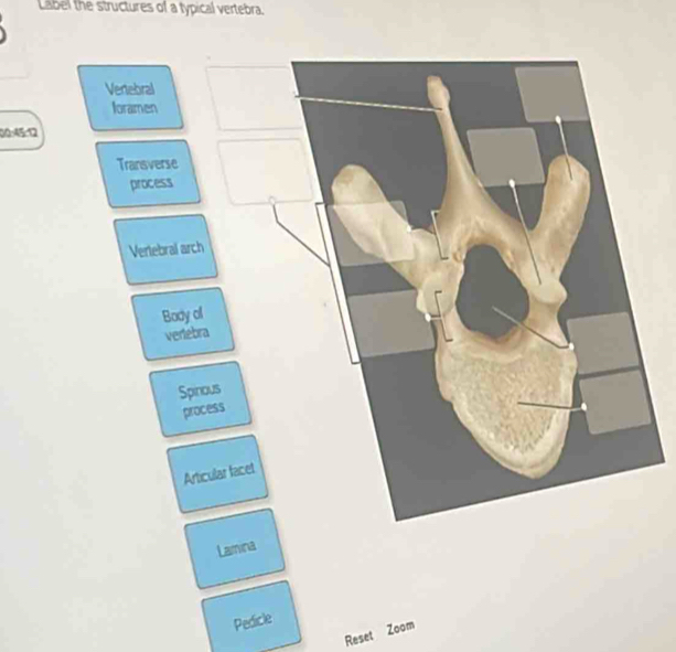 Label the structures of a typical vertebra. 
00-45:12 
Lamina 
Pedicle 
Reset Zoom