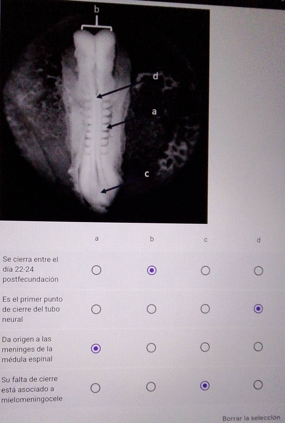 Se cierra entre el 
día 22-24 
postfecundación 
Es el primer punto 
de cierre del tubo 
neural 
Da origen a las 
meninges de la 
médula espinal 
Su falta de cierre 
está asociado a 
mielomeningocele 
Borrar la selección