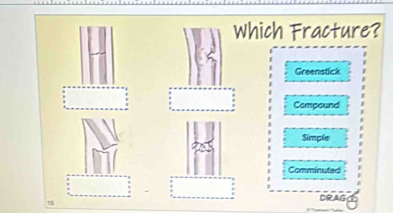 Which Fracture?
Greenstick
Compound
Simple
Comminuted
DRAG
15