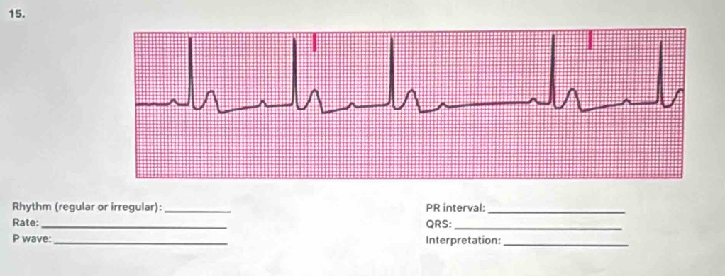 Rhythm (regular or irregular): _PR interval:_ 
Rate:_ QRS: 
_ 
P wave:_ Interpretation:_