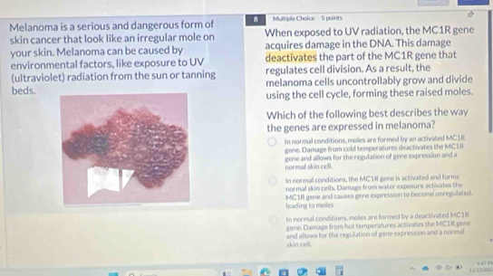 Melanoma is a serious and dangerous form of 8 Multiple Choice 5 points
skin cancer that look like an irregular mole on When exposed to UV radiation, the MC1R gene
your skin. Melanoma can be caused by acquires damage in the DNA. This damage
environmental factors, like exposure to UV deactivates the part of the MC1R gene that
(ultraviolet) radiation from the sun or tanning regulates cell division. As a result, the
beds. melanoma cells uncontrollably grow and divide
using the cell cycle, forming these raised moles.
Which of the following best describes the way
the genes are expressed in melanoma?
In normal conditions, moles are formed by an activated MC1R
gene. Damage from cold temperatures deactivates the MC1R
normal skin cell. gene and allows for the regulation of gene expression and a
In normal conditions, the MC1R gene is activated and forms
normal skin cells. Damage from water exposure activates the
leading to moles MC1R gene and causes gene expression to become unregulated.
In normal conditions, moles are formed by a deactivated MC1R
gene. Damage from hot temperatures activates the MC1R gene
skin cell. and allows for the regulation of gene expression and a normal