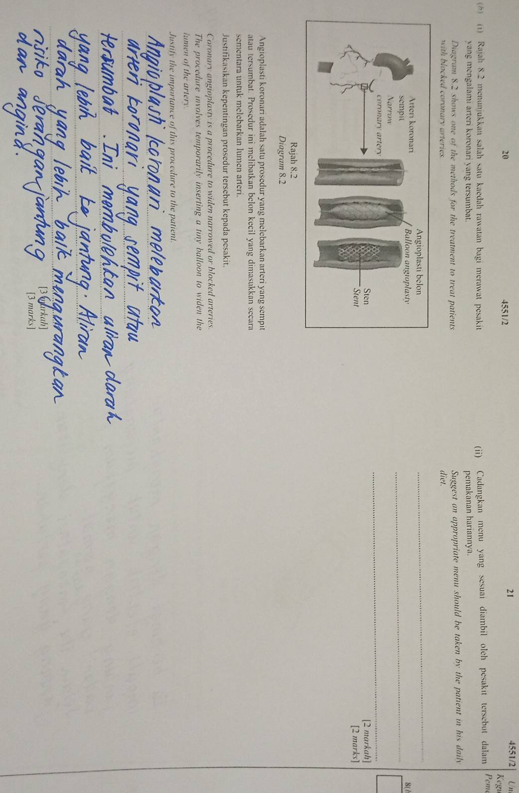 20 4551/2 
21 
4551/2 Un 
Kegı 
() (1) Rajah 8.2 menunjukkan salah satu kaedah rawatan bagi merawat pesakit 
(ii) Cadangkan menu yang sesuai diambil oleh pesakit tersebut dalam Pem 
yang mengalami arteri koronari yang tersumbat. pemakanan hariannya. 
Diagram 8.2 shows one of the methods for the treatment to treat patients Suggest an appropriate menu should be taken by the patient in his daily 
with blocked coronary arteries. 
diet. 
_ 
8( / 
_ 
_ 
[2 markah] 
[2 marks] 
Rajah 8.2 
Diagram 8.2 
Angioplasti koronari adalah satu prosedur yang melebarkan arteri yang sempit 
atau tersumbat. Prosedur ini melibatkan belon kecil yang dimasukkan secara 
sementara untuk melebarkan lumen arteri. 
Justifikasikan kepentingan prosedur tersebut kepada pesakit. 
Coronary angioplasty is a procedure to widen narrowed or blocked arteries. 
The procedure involves temporarily inserting a tiny balloon to widen the 
lumen of the artery 
Justify the importance of this procedure to the patient 
_ 
[3 markah] 
[3 marks]