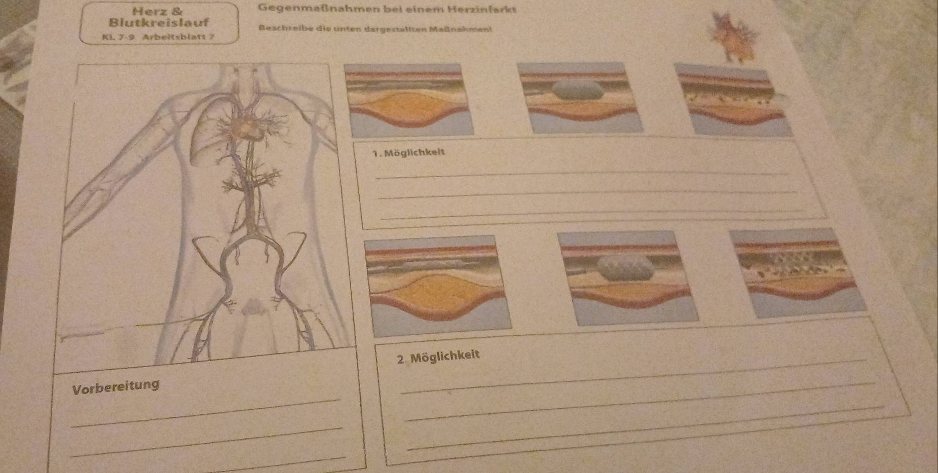 Herz & Gegenmaßnahmen bei einem Herzinfarkt 
Blutkreislauf Beschreibe die unten dargestellten Maßnahmen! 
KI. 7 - 9 Arbeitsblatt ? 
1. Möglichkeit 
_ 
_ 
_ 
2. Möglichkeit 
_ 
Vorbereitung 
_ 
_ 
_ 
_