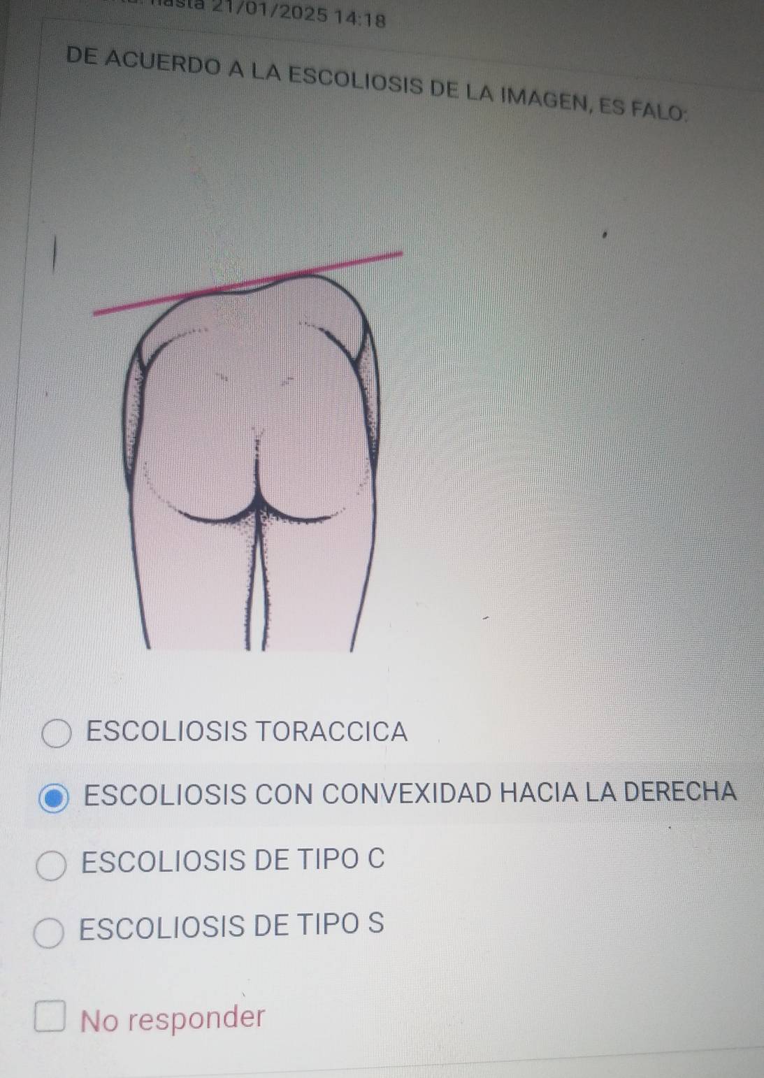 astá 21/01/2025 14:18 
DE ACUERDO A LA ESCOLIOSIS DE LA IMAGEN, ES FALO:
ESCOLIOSIS TORACCICA
ESCOLIOSIS CON CONVEXIDAD HACIA LA DERECHA
ESCOLIOSIS DE TIPO C
ESCOLIOSIS DE TIPO S
No responder