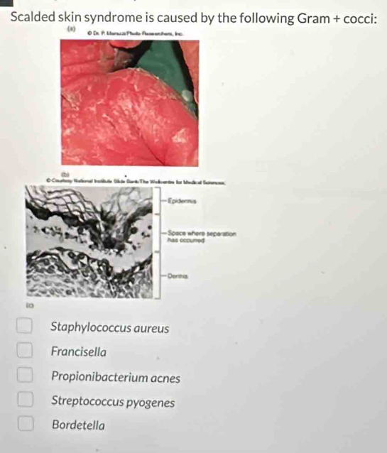 Scalded skin syndrome is caused by the following Gram + cocci:
(a) C raci Pulo Paeechers, inç
Staphylococcus aureus
Francisella
Propionibacterium acnes
Streptococcus pyogenes
Bordetella