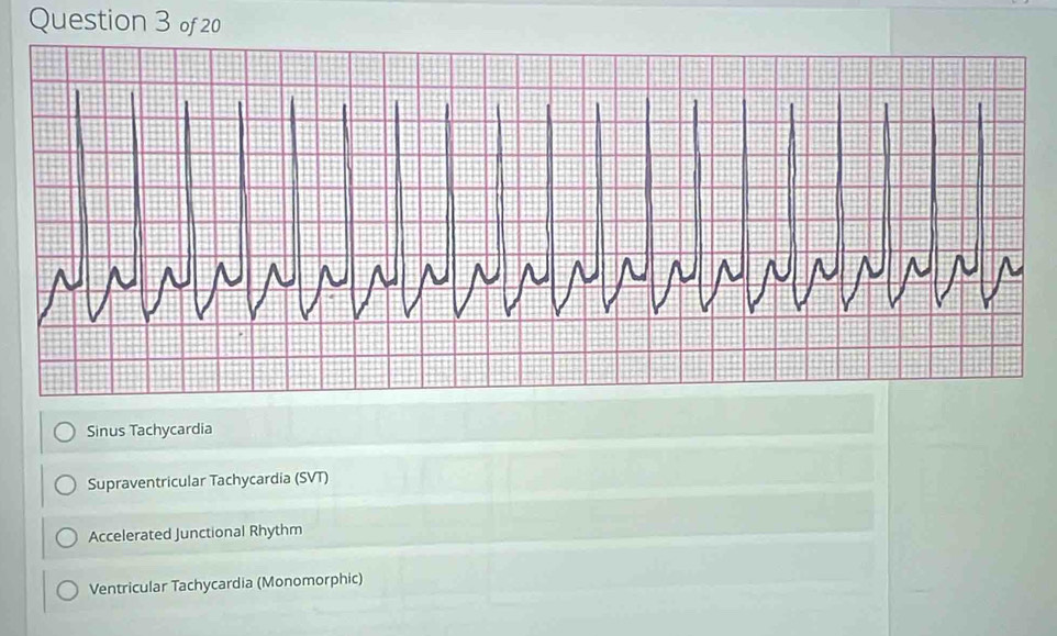 Solved: Sinus Tachycardia Supraventricular Tachycardia (SVT ...