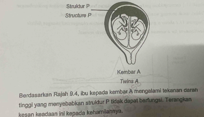 Struktur P 
Structure P 
Kembar A 
Twins A 
Berdasarkan Rajah 9.4, ibu kepada kembar A mengalami tekanan daran 
tinggi yang menyebabkan struktur P tidak dapat berfungsi. Terangkan 
kesan keadaan ini kepada kehamilannya.