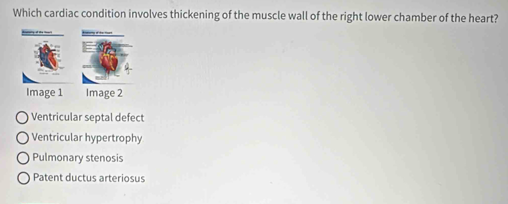 Which cardiac condition involves thickening of the muscle wall of the right lower chamber of the heart?
Ventricular septal defect
Ventricular hypertrophy
Pulmonary stenosis
Patent ductus arteriosus