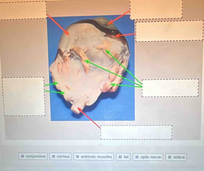 optic nerve sclera