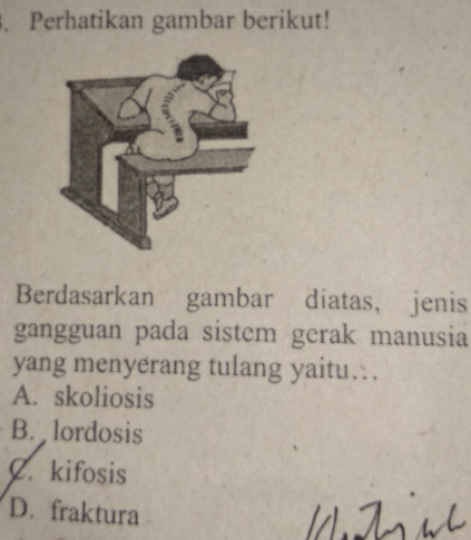 Perhatikan gambar berikut!
Berdasarkan gambar diatas, jenis
gangguan pada sistem gerak manusia
yang menyerang tulang yaitu….
A. skoliosis
B. lordosis
C. kifosis
D. fraktura