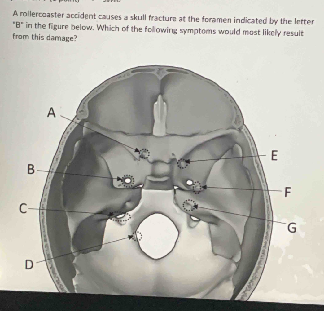 A rollercoaster accident causes a skull fracture at the foramen indicated by the letter 
"B" in the figure below. Which of the following symptoms would most likely result 
from this damage?