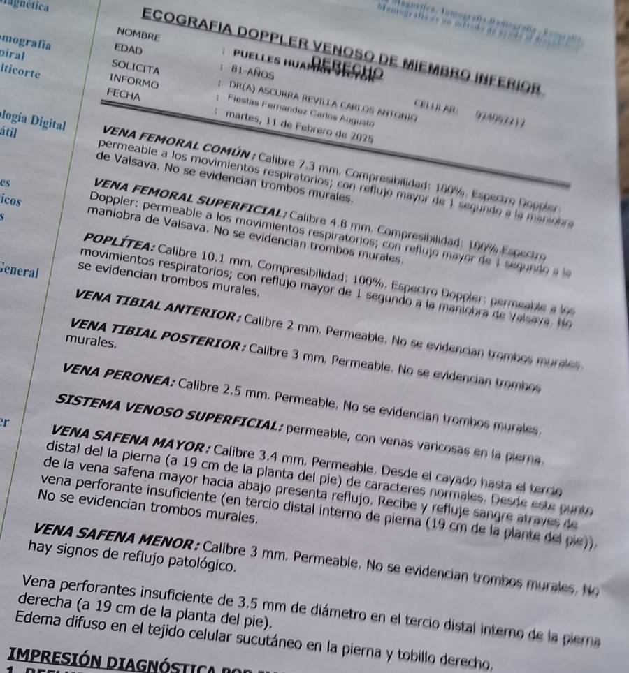 Hagnética
Tognáfica Tomografía Badiografía  Esogr              
EDAD
Ecografía Doppler venoso de miembro inférior
NOMBRE : PUELLES HUAMN Debeçho
oiral
mografía SOLICITA ; 81-Años
Iticorte INFORMO : DR(A) ASCURRA REVILLA CARLOS ANTONIO
FECHA
Fiestas Fernandez Carlos Áugusto
CELUBAB： 924057217
martes, 11 de Febrerç de 2025
logía Digital  VENA FEMORAL COMÚN: Calibre 7.3 mm. Compresibilidad: 100%, Espectro Doppler
de Valsava. No se evidencian trombos murales.
á til permeable a los movimientos respiratorios; con reflujo mayor de 1 segundo a la manioon
VENA FEMORAL SUPERFICIAL; Calibre 4.8 mm. Compresibilidad; 100% E t
es  Doppler: permeable a los movimientos respiratorios; co  refu jo may or de 1 segun oe 
icos maniobra de Valsava. No se evidencian trombos murales.
General
PoPLÍTEA: Calibre 10.1 mm. Compresibilidad; 100%, Espectro Doppler: permea l a   
se evidencian trombos murales.
movimientos respiratorios; con reflujo mayor de 1 segundo a la maniobra de V alsav a   
VENA TIBIAL ANTERIOR : Calibre 2 mm. Permeable. No se evidencian trombos muraes 
murales.
VENA TIBIAL POSTERIOR: Calibre 3 mm. Permeable. No se evidencian tromb
VENA PERONEA: Calibre 2,5 mm. Permeable, No se evidencian trombos murales
SISTEMA VENOSO SUPERFICIAL: permeable, con venas varicosas en la i 
r  VENA SAFENA MAYOR : Calibre 3.4 mm, Permeable, Desde el cayado hasta el tercio
distal del la pierna (a 19 cm de la planta del pie) de caracteres normales. Desde este punto
de la vena safena mayor hacía abajo presenta reflujo, Recibe y refluje sangre atraves de
No se evidencian trombos murales.
vena perforante insuficiente (en tercio distal interno de pierna (19 cm de la plante del pie).
hay signos de reflujo patológico.
VENA SAFENA MENOR : Calibre 3 mm. Permeable. No se evidencian trombos murales. N
Vena perforantes insuficiente de 3.5 mm de diámetro en el tercio distal interno de la piera
derecha (a 19 cm de la planta del pie).
Edema difuso en el tejido celular sucutáneo en la pierna y tobillo derecho,
IMPRESIÓN DIAGNÓSTica  do