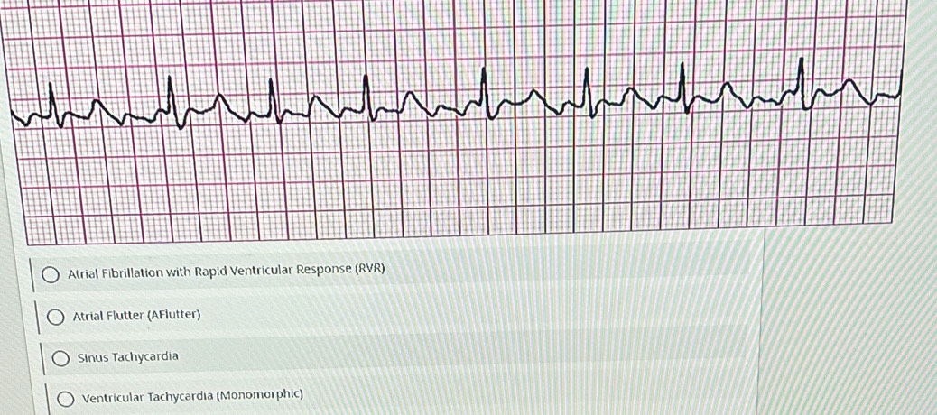 Solved: Atrial Fibrillation with Rapid Ventricular Response (RVR ...