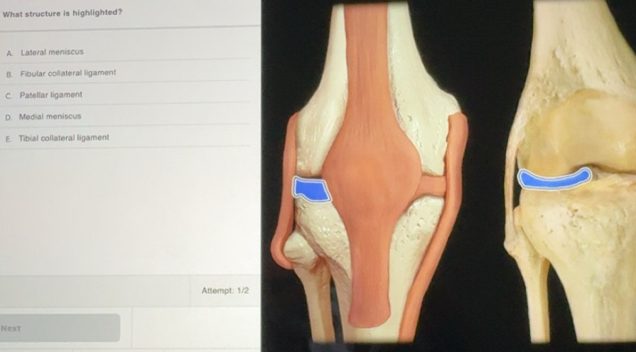 Solved: What structure is highlighted? A. Lateral meniscus B. Fibular ...