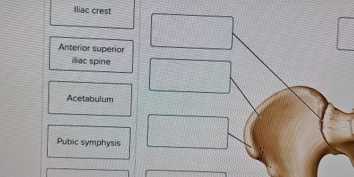 Iliac crest
Anterior superior
iliac spine
Acetabulum
Pubic symphysis